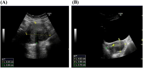 Figure 3. The ultrasound scan before and after combination therapy. (A) Ultrasound image of the adenomyotic uterus before HIFU treatment, which indicated the long diameter and anteroposterior diameter of the uterus to be 8.05 mm and 5.99 mm, respectively. (B) Ultrasound image of the patient’s uterus 12 months after combination therapy, which indicated the long diameter and anteroposterior diameter of the uterus to be 4.62 mm and 3.98 mm, respectively. The size of the uterus was almost normal.