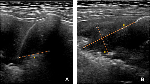 Figure 1 Lung ultrasound imaging. (A) The longitudinal axis dimension of lung consolidation (line a); (B) The transverse axis and sagittal axis dimensions of lung consolidation (lines b and c, respectively).