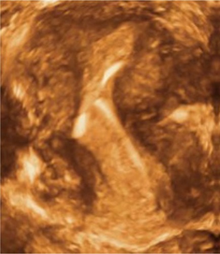 Figure 1 Severe distortion causing bleeding and painCitation13 due to incompatibility of the large T-shaped IUD and the narrow uterine cavity.