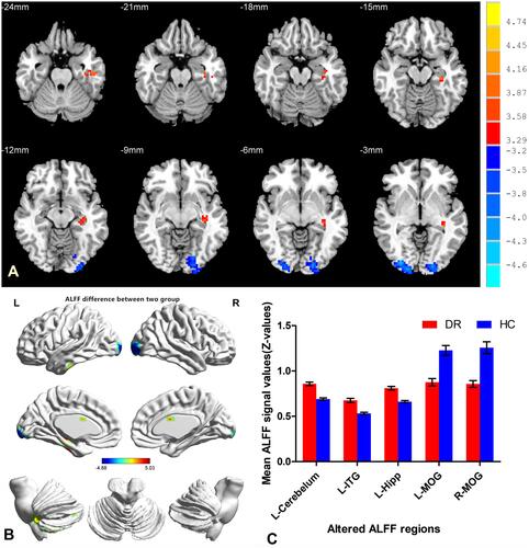 Figure 3 Spontaneous brain activity in the DRs and HCs.