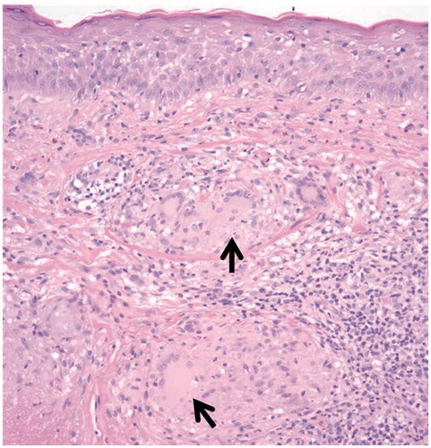 Figure 3. Light microscopic appearance of the skin biopsy demonstrating noncaseating granulomatous inflammation with multinucleated giant cells (arrows) in a patient with scleral sarcoid nodule (original magnification 200×).