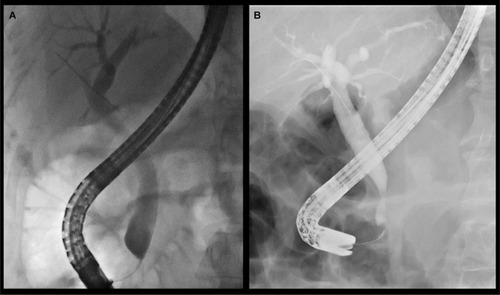 Figure 2 (A, B) Examples of distal common bile-duct strictures associated with chronic pancreatitis. Note: Both strictures are relatively smooth with mild upstream biliary dilatation.