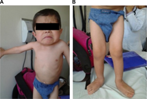 Figure 3 Physical examination of a patient with OI type III: (A) thorax and (B) lower limbs with hypotrophy and genu valgus.
