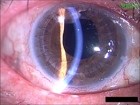 Figure 3 Photograph of anterior segment at 8 months after keratoplasty and ciliary sulcus fixated intraocular lens implantation. Note that graft remained clear with HCL corrected visual acuity of 20/40.