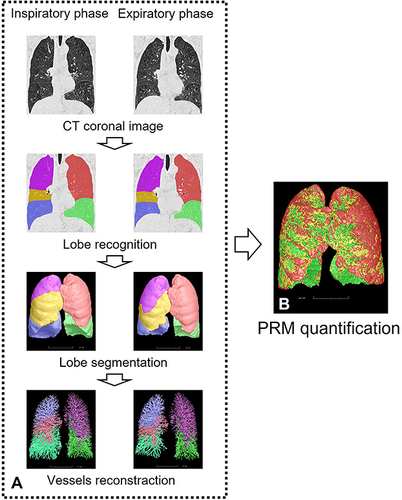 Figure 2 Schematic diagram of parameter measurement in biphasic quantitative CT.