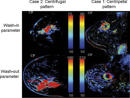 Figure 2. DCE-MRI perfusion patterns in locally advanced breast cancer Citation[26]. Left panel shows a centrifugal pattern, with central contrast medium filling seen in the wash-in and wash-out parameters (top vs. bottom). Right panel is a tumour exhibiting a centripetal pattern. Data reproduced with permission from the publisher and author.