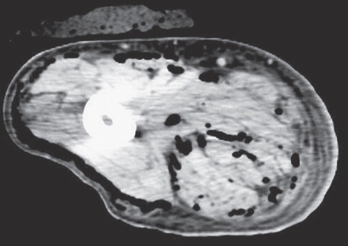 Figure 1. Computed tomography of the right thigh of case 1. A circumferential gas pattern was observed.