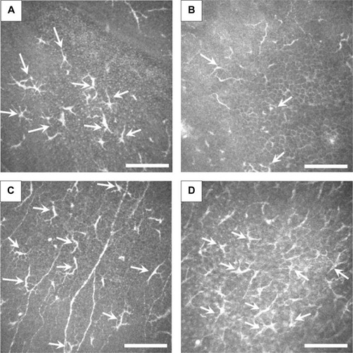 Figure 3 In vivo confocal microscopic images at the level of deep epithelium to subbasal nerve plexus in Case 1 (A), Case 2 (B), Case 3 (C), and Case 4 (D).