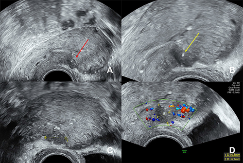 Figure 6 Transvaginal ultrasound in September 2023, four months postpartum. (A) Uterus depicted in the sagittal plane. The cystic adenomyoma appears as an unremarkable, ill-demarcated, hypoechoic area (red arrow) in the anterior uterine wall. (B) Located within the hypoechoic area are the characteristic white spots (yellow arrow). (C) Uterus depicted in the transverse plane. The cystic adenomyoma in the anterior uterine wall extends to the ventral surface of the uterus. (D) No vascularization can be detected within the hypoechoic area. The surrounding myometrium is well vascularized. The measurement lines indicate the dimensions of the cystic adenomyoma (10.8x6.7mm).