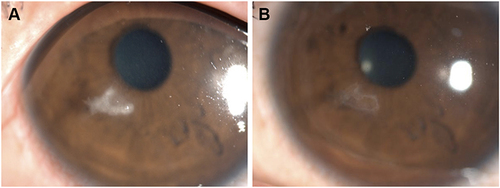 Figure 2 A 23-year-old man with a paracentral white cross infiltrate at the corneal cap–stromal bed interface 3 days after SMILE in his left eye (A). At 1 month after the surgical intervention, the cornea has only a trace of a residual peripheral scar, and the vision improved to 20/20 (B).