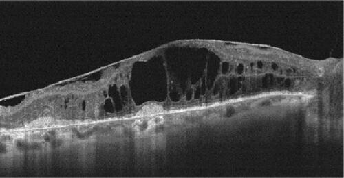Figure S2 OCT image of an epiretinal membrane 30 days after intravitreal dexamethasone injection.Abbreviation: OCT, optical coherence tomography.