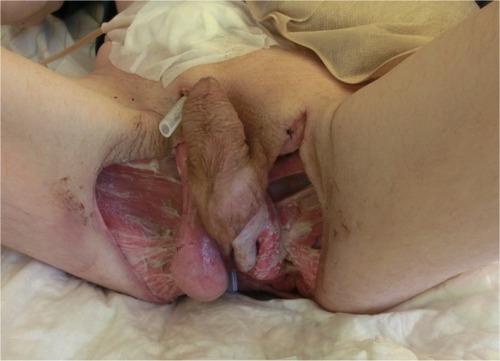 Figure 6 Debridement, suprapubian catheter change and subcutaneous testicle relocation towards the inguinal region – shown is the 30th day post-surgery.