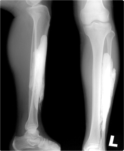 Figure 1. Preoperatively, large radiopaque mass in the anterolateral aspect of the left lower leg.