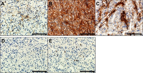 Figure 1 (A–C) Immunohistochemical staining for B7-H3 in tumor cells and the tumor vasculature of clear cell renal cell carcinoma. (A) Representative tumor with low B7-H3 expression in tumor cells and the tumor vasculature. (B) Representative tumor with high B7-H3 expression in tumor cells. (C) Representative tumor with high B7-H3 expression in the tumor vasculature. (D and E) Immunohistochemical staining for FOXP3 in tumor-infiltrating cells in clear cell renal cell carcinoma. (D) Representative tumor with a low FOXP3+ cell density. (E) Representative tumor with a high FOXP3+ cell density. Scale bar, 100 µm.