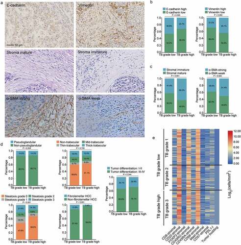 Figure 3. Associations of tumor budding with pathological and immune features. (a) representative images of E-cadherin, vimentin, α-SMA and stromal maturity. (b) Associations of tumor budding with E-cadherin and vimentin expressions (E-cadherin and vimentin were divided into high and low groups by the median values of expression levels). (c) Associations of tumor budding with stromal features including α-SMA expression and tumor maturity. (d) Associations of tumor budding with HCC pathological patterns including pseudoglandular, trabecular, steatotic, cirrhotic-HCC and tumor differentiation. (e) the heat map shows the main immune cell infiltrations linked to tumor budding grade. PDL1-I, PDL1-immune cells