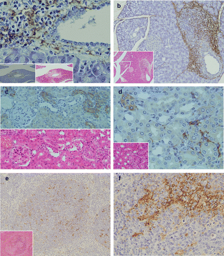 Figure 3 Pathological findings and immunohistochemical staining of LTA in the pancreas, kidney and spleen. (a) In the pancreas, marked inflammatory cellular infiltrates around pancreatic ducts were observed (H&E, lower middle column). LTA was located in the cytoplasm of polymorphic inflammatory cells and in the stromal connective tissue around pancreatic ducts (lower magnification in the left lower corner). (b) In another TCRα− / − × AIM− / − mouse, marked inflammatory cellular infiltrates around pancreatic ducts were observed (H&E, lower left corner). LTA was also detected in the cytoplasm of polymorphic inflammatory cells and the stromal connective tissue around pancreatic ducts (immunohistochemistry). (c) In the kidney, mild inflammatory cellular infiltrates around renal tubuli were observed (H&E, lower left corner). LTA immunoreactivity was detected in the cytoplasm of polymorphic inflammatory cells, and in the stromal connective tissues of the cortex. (d) In another TCRα− / − × AIM− / − mouse, LTA immunoreactivity was detected in the cytoplasm of some distal renal tubuli. Lower half shows H&E staining of the sequential sliced section. (e) LTA immunoreactivity was mainly detected in the cytoplasm of lymphocytes in the white pulp of the spleen. Lower left corner shows H&E staining. (f) In the same sample as (e), at a higher magnification of the spleen, LTA immunoreactivity was mainly detected in the cytoplasm of lymphocytes in the white pulp.