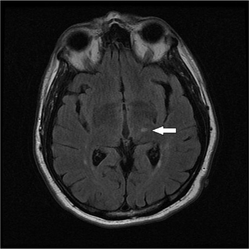 Fig. 2 Axial T2 FLAIR MR image demonstrating subacute lesion with hyperintense signal in Lt. posteroinferolateral region of thalamus (arrow).