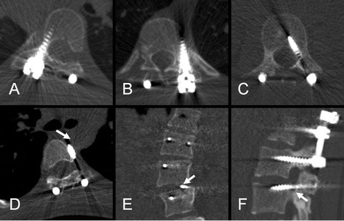 Figure 1. Axial (A–D), coronal (E) and sagittal (F) images obtained by low-dose spine CT from 6 patients. A. Normally-placed screw through the right pedicle of T7. B. Screw with total lateral cortical perforation (LCP grade 2) at the level of T9. C. Screw with total medial cortical perforation (MCP grade 2) at the level of L3. D. Pedicle screw with anterior cortical perforation (ACP) with screw tip in close proximity to the posterior-lateral limit of aorta (arrow). This screw was removed a few months later. E. Screw tip perforating the upper endplate of L4 (arrow) on the left side (EPP). F. Screw passing through the lower boundary of the neural foramen (FP) below L3 (arrow).