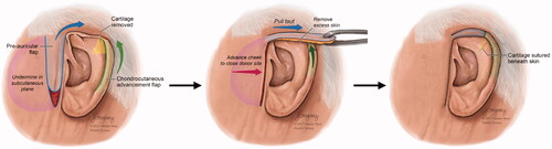 Figure 2. Diagram showing the repair procedure consisting of a unilateral chondrocutaneous advancement (Antia-Buch) flap to improve the shape of the ear and a pre-auricular fasciocutaneous transposition flap to provide skin coverage.