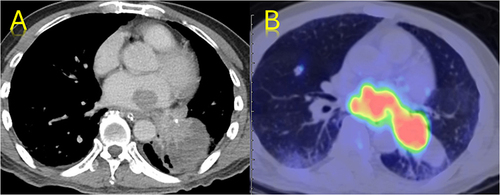 Figure 4 (A) Contrast-enhanced axial CT and (B) PET/CT fusion images of the thorax showing a left lung mass invading the left atrium and pulmonary vein.