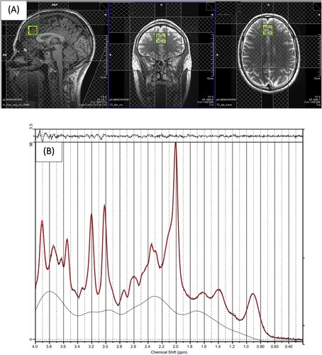 Figure 1. (A) Example of 1H-MRS voxel placement in the mPFC (sagittal, coronal, and axial orientations) (B) 1H-MRS spectrum obtained from the voxel in A (black line) and the overlay of the spectral fit (red line).