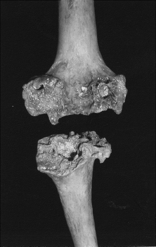 Figure 2. Posterior view of emu (Dromaius novaehollandiae) knee. Severe disruptive changes of infectious arthritis.