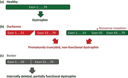 Figure 1. Mutations in the DMD gene. (a) In the healthy situation the dystrophin mRNA transcript encodes a fully functional dystrophin protein. (b) In Duchenne patients, mutations that disrupt the reading frame (e.g. a deletion of exon 52, left panel) or nonsense mutations (e.g. nonsense mutation in exon 42, right panel) lead to a premature truncation of protein translation and non-functional dystrophins. (c) In Becker patients mutations maintain the reading frame (a deletion of exon 51 and 52), allowing production of internally deleted, but partially functional proteins.