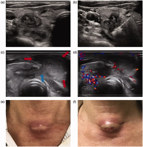 Figure 4. A male patient experienced SAN with nodule rupture after MWA. (a) The nodule was in the right thyroid lobe and shown as heterogeneous hypoechoic lesion on US image. The pathology result was nodular goiter and the tumor size was 2.6 × 1.6 × 1.6 cm; (b) MWA procedure of the thyroid lesion; (c) breakdown of the thyroid capsule (blue arrow) and the necrosis ruptured into the cervical strap muscles (red arrow). (d) Color Doppler of the ruptured lesion and normal thyroid tissue; (e) the skin appearance at the time of US image c acquired in this figure; (f) the skin appearance before incision drainage. SAN: symptomatic aseptic necrosis; MWA: microwave ablation; US: ultrasound.