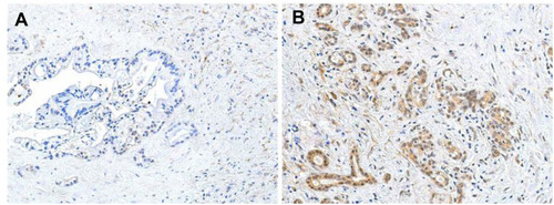 Figure 5 Representative immunohistochemical images of low and high expression of COL6A1 in PC patient tissues. (A) Low expression of COL6A1 in PC without DM; (B) high expression of COL6A1 PC with DM.