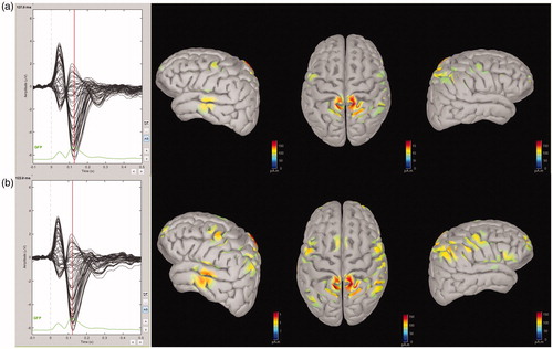 Figure 5. Source localization of N1. Grand averaged data showed the N1 source distributions of pre- (a) and post-tetanus (b) conditions.