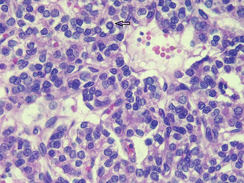 Figure 5 High power view (600x) showing classic cytomorphologic features of PTC with washed out chromatin, nuclear elongation, grooving and pseudo inclusions (arrows).