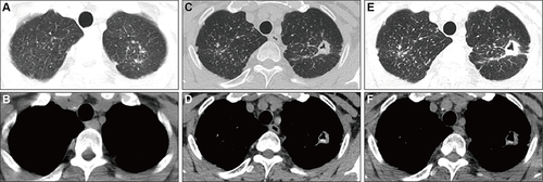 Figure 2 Serial chest computed tomography (CT) scans of the patient. (A and B) July 4, 2017. (C and D) November 9, 2022. (E and F) March 2, 2023.