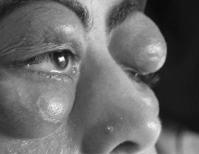Figure 1 Pre-treatment photography of the patient shows a swollen mass of bilateral upper and lower eye-lid over a six-month period.