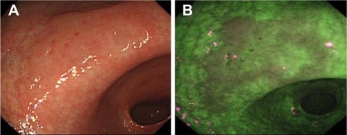 Figure 5 Example images of a suspected early cancer of the gastric antrum, imaged using standard WLE (A) and AFI (B), to demonstrate the contrast enhancement provided by AFI (Olympus Corporation, Tokyo, Japan).