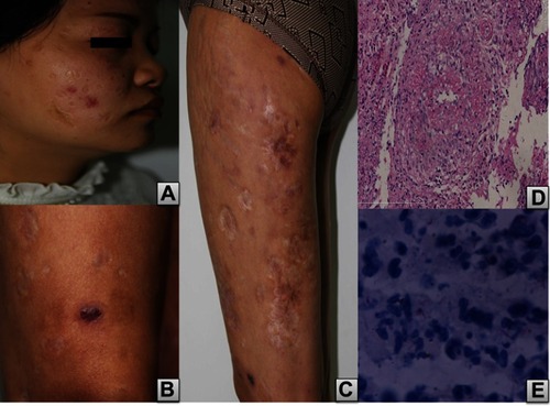 Figure 1 Clinical manifestations and histopathological characteristics.Notes: Dark-red macule and atrophic scars over the face (A), a soya-bean sized dark fuchsia nodule presents on the right leg (B), dark-red macule and large areas of stellate scars over the left thigh (C). The lesion on the edge of ulceration of the lower back displays necrosis of epidermis and dermis, thickening of vascular walls, with local foam cells, swelling of endothelial cells, intraluminal thrombus (D: H&E, ×40), positive for bacillus (E: acid-fast stain, ×400).