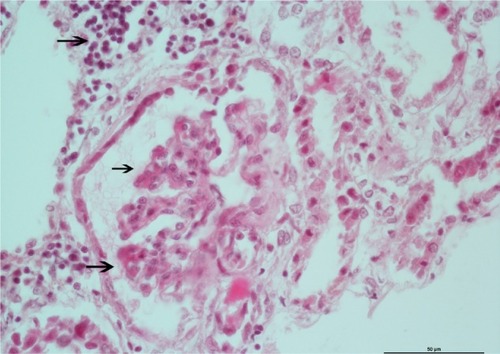 Figure 1 Renal biopsy specimen showing focal necrotizing glomerulonephritis in the patient.