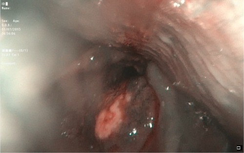 Figure 1 Case 1: examination of patient’s entry to the larynx with a fiber-optic scope performed by an ear, nose and throat surgeon before the operation.