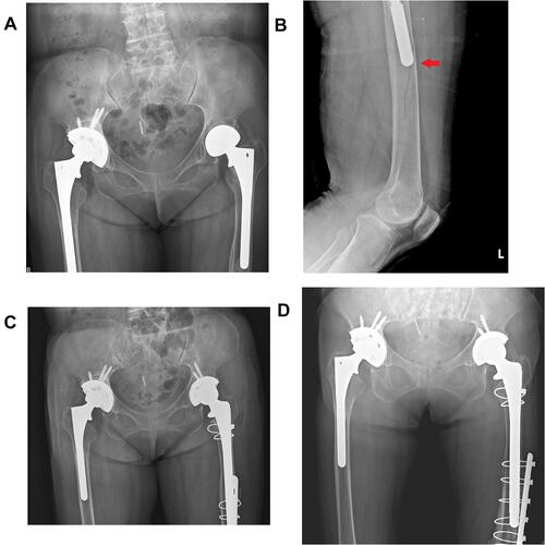 Figure 3 Pelvis and femoral radiograph of 58-year-old patient suffered from stem loosening after primary THA, intraoperative tip fracture during RTHA, and revision with long stem combined additional ORIF. (A) Aseptic loosening of left femoral stem before RTHA surgery. (B) Intraoperative radiograph revealed periprosthetic femoral shaft split fracture over stem tip (red arrow). (C) Immediate ORIF was performed combined full-porous-coated long stem RTHA. (D) 5 years postoperative radiograph revealed stable prosthesis and fracture union.