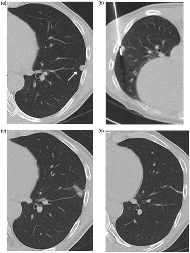 Figure 3. Axial CT images from 60-year-old man with solitary pulmonary metastasis from renal cell carcinoma in the left lower lobe treated by MWA. (a) CT image prior to ablation showing a sub-pleural-rounded pulmonary metastasis of 8 mm axial diameter located on the lateral aspect of left lower lobe (arrow). (b) Image obtained during the ablation therapy. (c) Image obtained 3 months post-ablation showing reticular retraction of the ablation due to progressive scarring. (d) Axial CT image 18 months post-ablation showing a residual scarring in the ablation bed denoting complete ablation of the lesion.