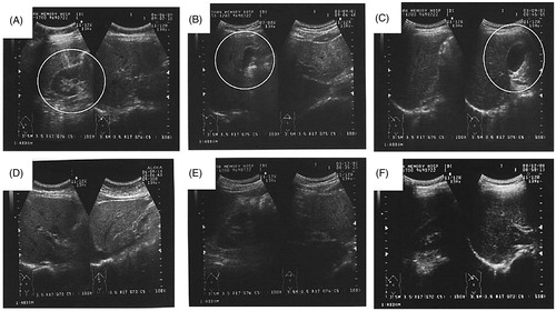 Figure 2. The abdominal ultrasonic image of GL-treated healthy subjects. Image A, B and C represents subject no. 10, 19 at baseline with mild fatty liver and subject no. 36 at baseline with gall bladder polyp (indicated with a circle). Image D, E and F represents subject no. 10, 19 and 36 after 6 months of GL treatment display normal hepatic structure without any signs of fatty liver or gallbladder polyp.