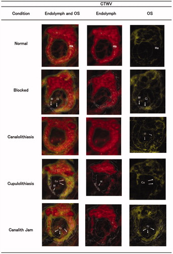 Figure 3. Five representative conditions of HC conditions, namely, normal, blocked, canalith jam, canalolithiasis and cupulolithiasis. The selection of CTWV shows its relative substance in the image. Column 1: HC image with three CTWVs, which are endolymph (red color), OS (yellow color) and bone (white color). Column 2: HC image with two CTWVs, which are endolymph (red color) and bone (white color). Colum 3: HC image with two CTWVs, which are OS (yellow color) and bone (white color). CTWV: CT window value; Bl: blocked; Cj: canalith jam; Cl: canalolithiasis; Cu: cupulolithiasis; Ha: ampulla of HC; HC: horizontal canal; OS: otoconia-like substance.