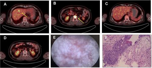 Figure 2 (A) Hepatic metastatic lesion and (B) bone metastases on PET-CT (captured on Nov. 11th, 2019). (C and D) Confirmation of CR after second line nivolumab and paclitaxel (captured on April 8th, 2020). (E) Cystoscopy showed that the entire bladder mucosa was edematous. (F) Histology of urothelium. Significant abnormal findings were noted (arrow).