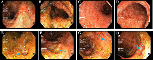 Figure 1 Total colonoscopy images. (A–D) First procedure performed on January 9, 2022, showing mucosal redness, edema, granular change, and multiple small mucosal ulceration. (E–H) Second procedure performed on January 28, 2022, showing multiple deep oval ulcers (arrows).