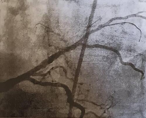 Figure 3 CT angiogram post percutaneous coronary intervention.