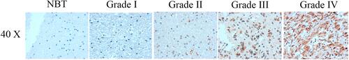 Figure 3 Representative patterns of KLF11 expression was detected by IHC in glioma tissues and normal brain tissues.