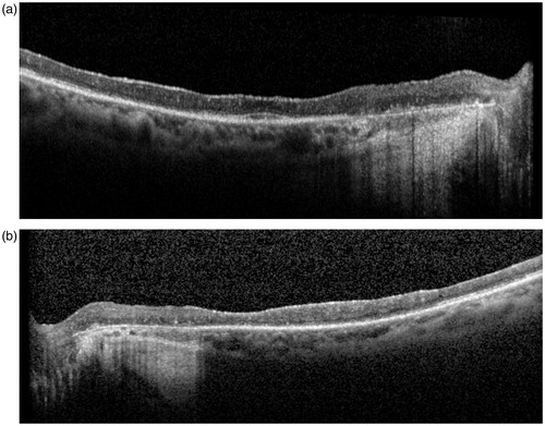 Figure 2. (a) Macular OCT OD. Loss of architecture of the inner retinal layers and diffuse atrophy of the outer layers. Residual photoreceptor layer can be seen in the foveal region. Nasal to the fovea, the RPE is atrophic (corresponding to atrophy seen in the colored fundus photograph). The choroid is visualized and appears atrophic. (b) Macular OCT OS. Shows a similar picture as OD with an irregular subfoveal photoreceptor layer. Nasal to the fovea, the RPE is atrophic.