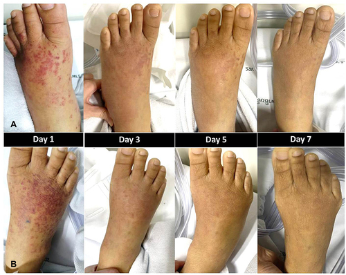 Figure 2 The improvement of the rash on left foot (A) and right foot (B) from day 1 to day 7.