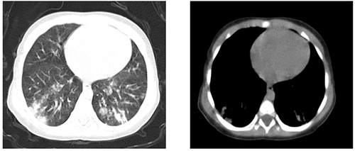 Figure 1 CT imaging findings of mild cases.