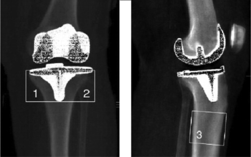 Figure 1. Periprosthetic regions of interest (ROIs) of the tibia: medial metaphyseal (1), lateral metaphyseal (2), and diaphyseal (3).