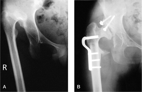 Figure 5 Case 11. A 14-year-old girl at the index operation (A) for dislocation of the right hip and at follow-up (B) after 32 months: dislocation of the hip and heterotopic ossification.